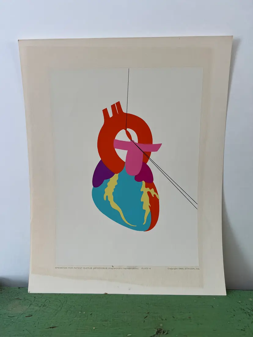 Mid Century Abstract Anatomy Medical Print: Ductus Arteriosus. Ethicon- Portfolio of Surgical Interventions