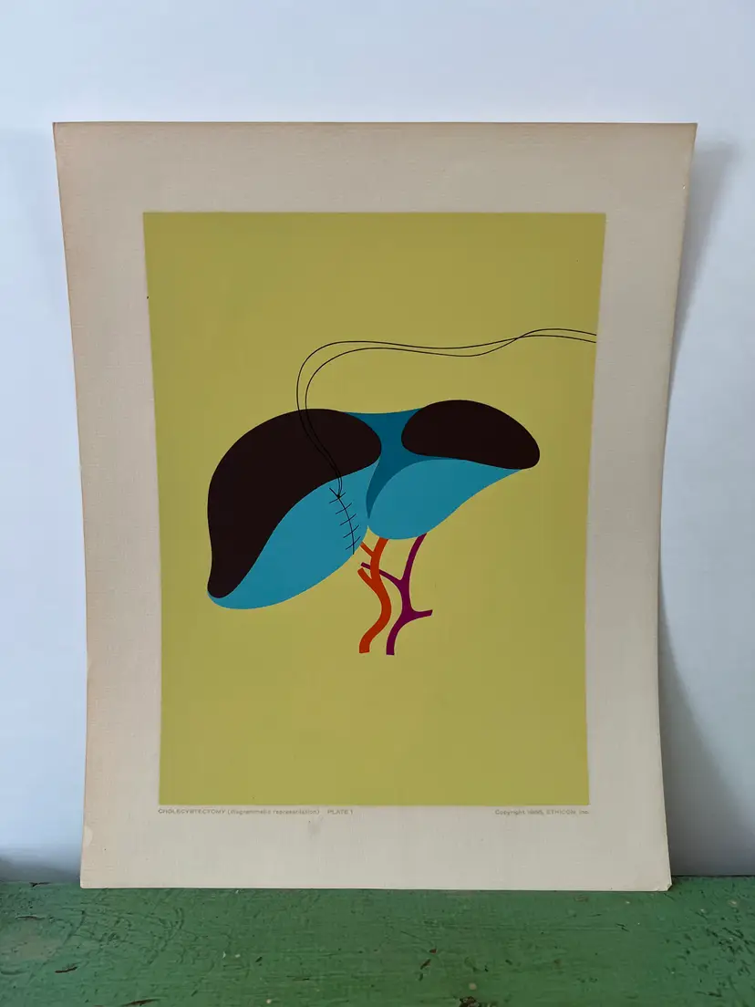 Mid Century Abstract Anatomy Medical Print: Cholecystectomy. Ethicon- Portfolio of Surgical Interventions