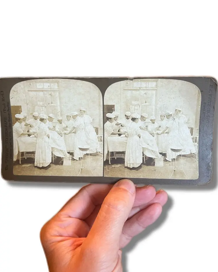 ANTIQUE 1905 SURGICAL LEG AMPUTATION STEREOVIEW PHOTO- Wounded Soldier