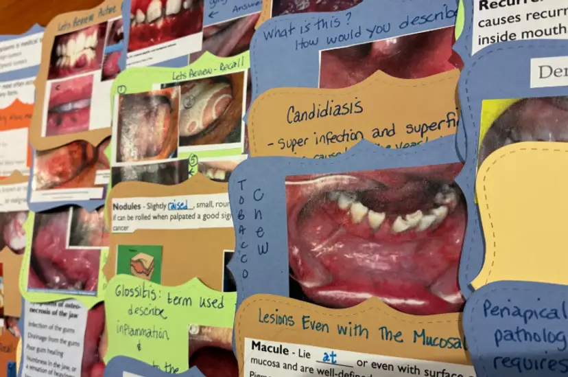 Oral Pathology Dental Flashcards